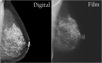 digital-mammogram